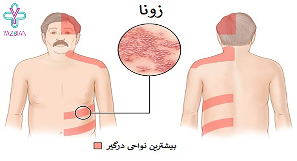 نواحی درگیری زونا 